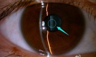 眼睛晶体多少钱 眼睛晶体多少钱